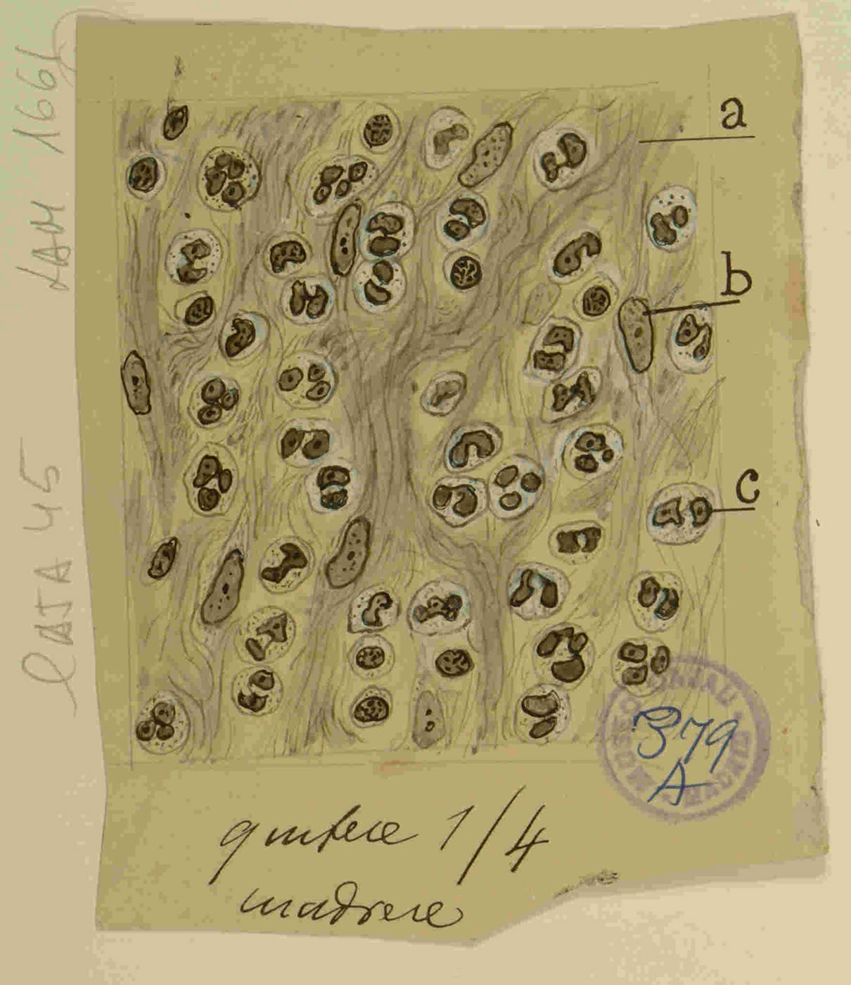 "Infiltrado inflamatorio agudo". Este dibujo, que muestra un denso infiltrado de leucocitos (neutrófilos, reconocibles por sus núcleos multilobulados), es la representación del resultado final del proceso de diapédesis. Mientras que otros dibujos de Cajal detallan el viaje de un solo 