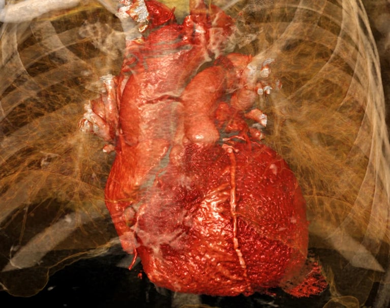 Cardiac damage caused by myocardial infarction