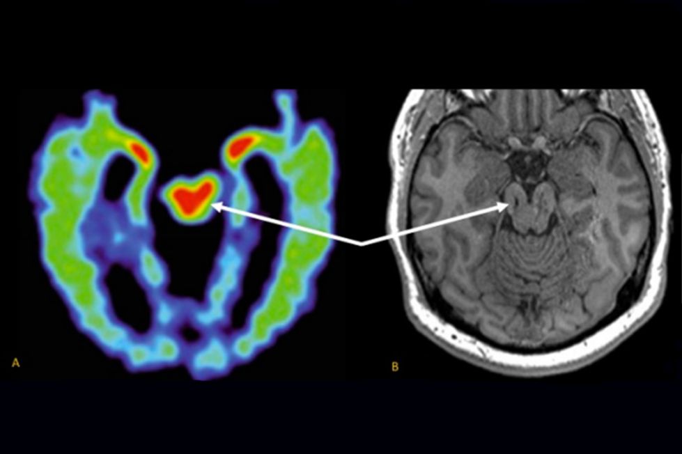 Resonancia magnética de una lesión cerebral. UCLA Health. Comparación entre una tomografía por emisión de positrones (PET) de un jugador de la NFL, que revela una acumulación anómala de proteínas característica de la encefalopatía traumática crónica (izquierda), y una resonancia magnética que muestra un mesencéfalo anormalmente pequeño en un antiguo jugador de fútbol americano de instituto. Ambos pacientes presentan sospecha de patología de ETC en la región del mesencéfalo (flechas).